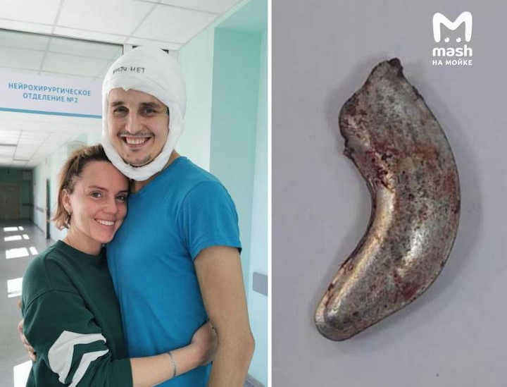 В Петербурге врачи достали из головы пациента железный крюк
